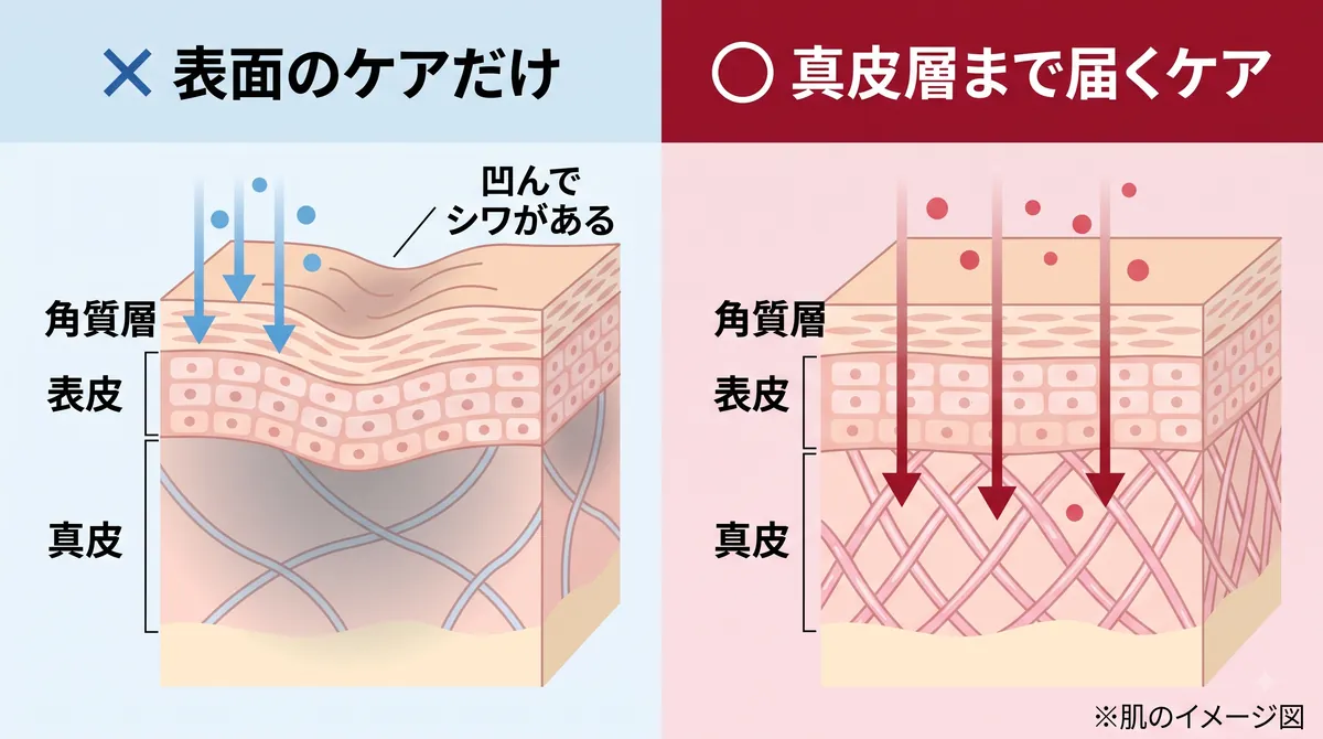 肌の断面図と真皮層へのアプローチ図解